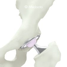 Hip Arthroplasty - Minimally Invasive Hip Surgery